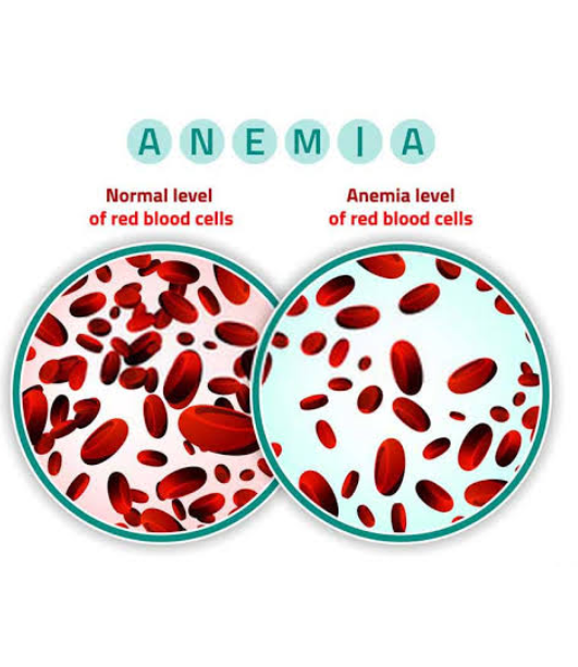 Anemia in Children