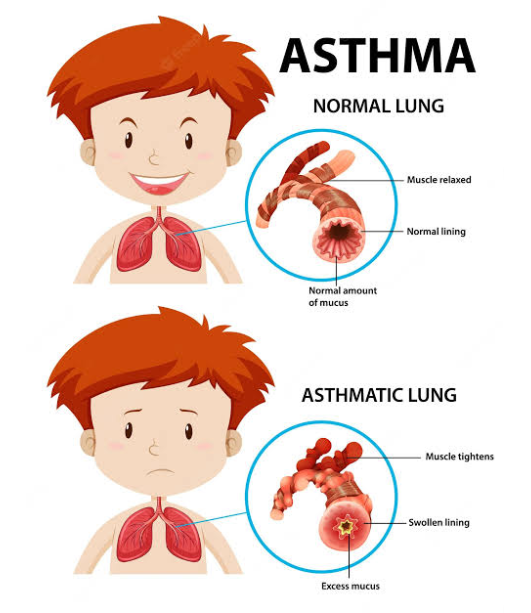 Asthma in Children